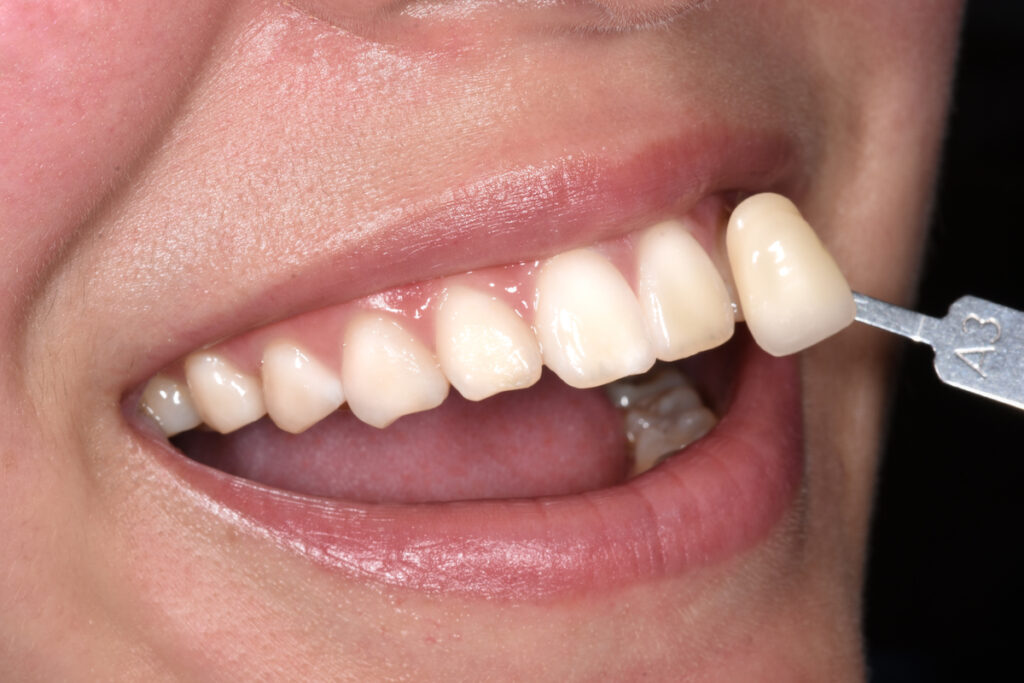 A3-shade-guide-against-upper-teeth-img